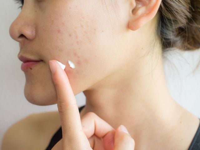 Person applying acne cream